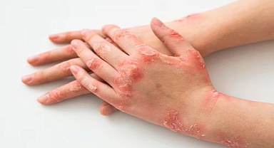 Bu hastalık kadınlarda 9 kat fazla görülüyor