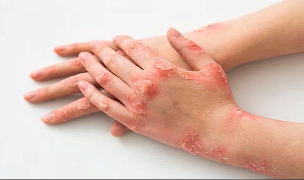 Bu hastalık kadınlarda 9 kat fazla görülüyor